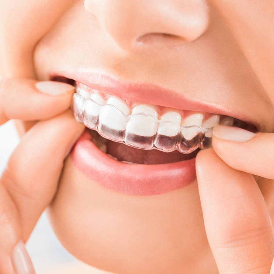 Braces1