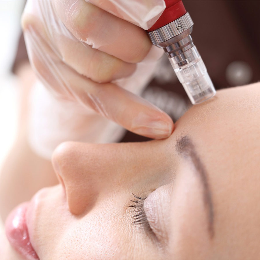 Dermapen-with-Mesotherapy-5